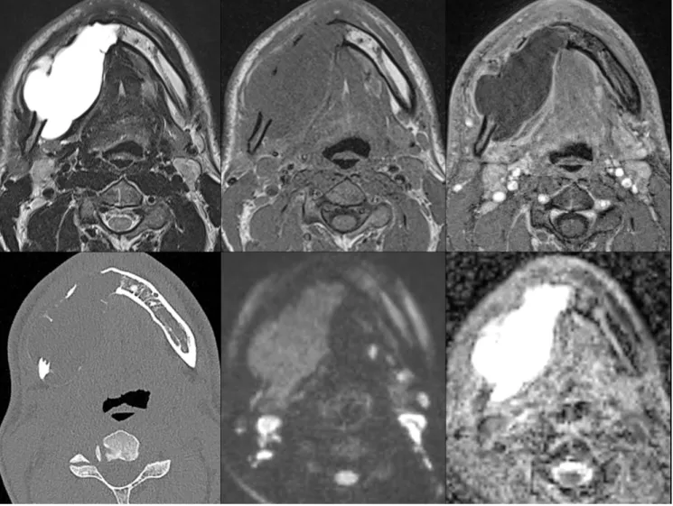 Figure 6. Exemple d’un Améloblastome en récidive : homme de 43 ans, lésion de la mandibule  droite d’aspect loculé, aspect soufflé des corticales, aspect en hypersignal T2, hyposignal T1,  pas  de  rehaussement  nodulaire  ou  mural  après  injection,  asp