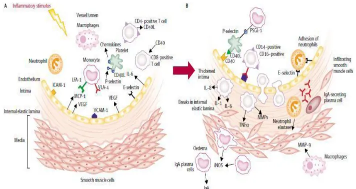 Figure 9. Hypothèse de l’évolution de la vascularite dans la MK (2) 