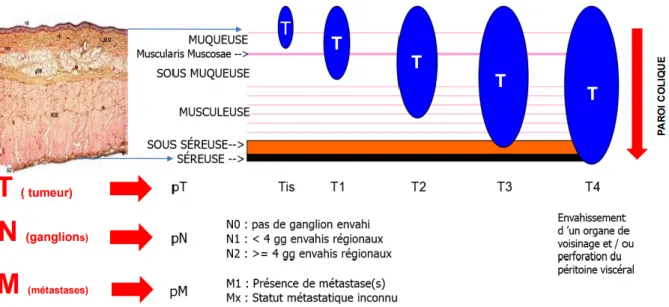 Figure 4 – Classification TNM du cancer colorectal 