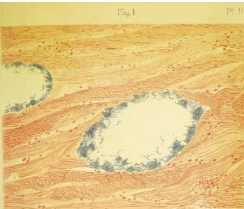 Figure 8 : « Veines intra-utérines dont les parois sont tapissées de streptocoques. (Détritus  granuleux dans la lumière de ces vaisseaux.) Objectif à immersion