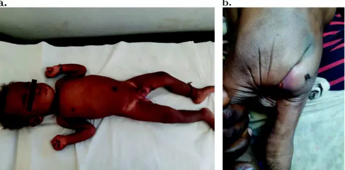 Figure 1 : Photos de cas cliniques de MA sévères. 1a : kwashiorkor probable (aspect érythémateux,  présence de dépigmentation cutanée d’apparition spontanée à l’interrogatoire et œdèmes des  pieds); 1b : marasme (pli cutané de dénutrition au niveau des fes
