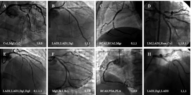 Fig. 2. Examples of coronary bifurcation lesions denomina- denomina-tion. A: Tight stenosis in the proximal circumﬂex artery, the mid circumﬂex artery was considered as the SB