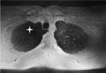 Figure 13: Séquence PETRA en coupe axiale: Artéfacts de shading au niveau de l'appex pulmonaire droit (étoile  blanche) où il existe une perte de signal comparativement au côté gauche controlatéral