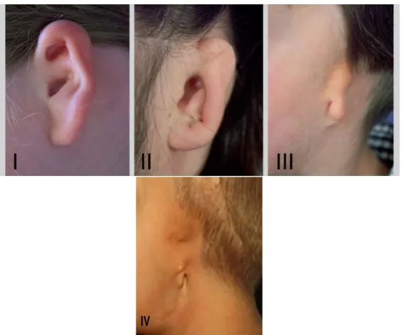 Figure 2: Les quatre grades d’aplasie d’oreille. Source : [2]. 