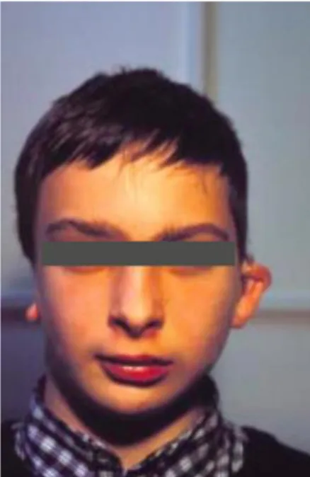 Figure 3 : Syndrome de Goldenhar : hypoplasie faciale asymétrique. 