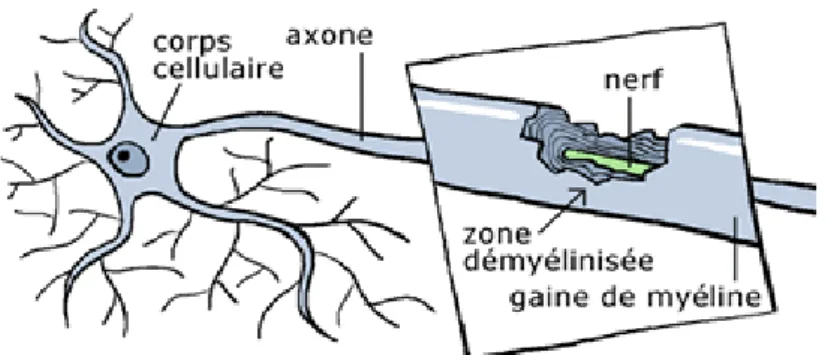 Figure 2 : Neurone démyélinisé. 