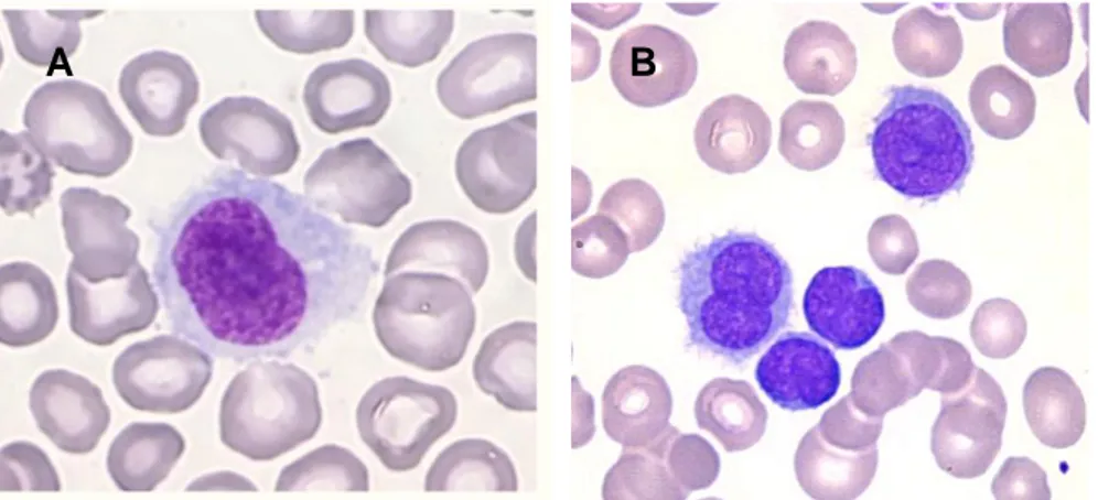 Figure 1 Tricholeucocytes dans le sang périphérique 