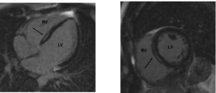 Figure 5 : IRM typique d’un patient porteur d’une laminopathie avec atteinte cardiaque   Réhaussement  tardif  myocardique  au  gadolinium  dans  la  région  médio-murale  du  septum   inter-ventriculaire
