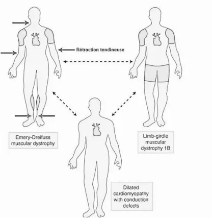 Figure 6 : Continuum phénotypique entre EDMD, DCM-CD et LGMD1B    