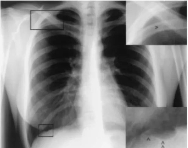 Figure 1 : Radiographie du thorax de face d’une  jeune  femme  de  25  ans  prise  en  charge  pour  pneumothorax  cataménial  droit  avec  mise  en  évidence  de  deux  bulles  d’air  en  regard  de  la  partie moyenne du diaphragme droit
