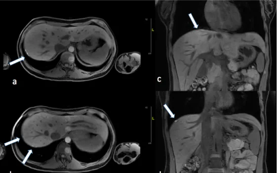 Figure  2 :  IRM  diaphragmatique  d’une  jeune  femme  de  29  ans  présentant  des  douleurs  scapulaires  cataméniales