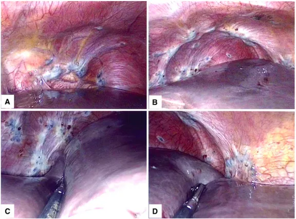 Figure  8 :  de  A  à  D :  aspect  per  opératoire  de  lésions  d’endométriose  diaphragmatique  profondes  (Ceccaroni et al (4))  