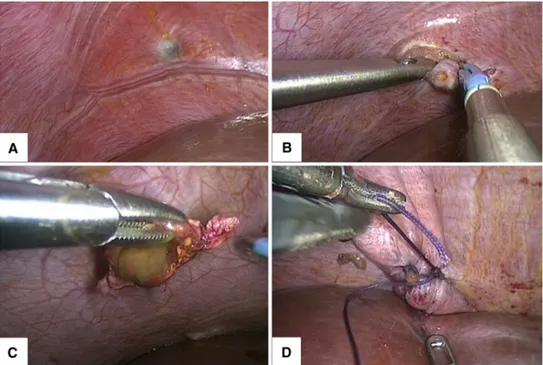 Figure  9  :  illustration  d’une  résection  diaphragmatique  droite  pour  nodule  profonde,  d’endométriose  (A),  par  voie  coelioscopique