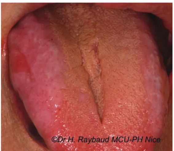Figure  10a : Lichen plan atrophique,  érosion traumatique, face dorsale de la  langue irréversiblement dépapillée,  femme de 82 ans 