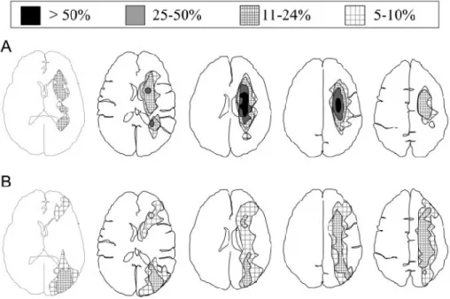 Figure 3 :  Topographie des infarctus jonctionnels en fonction de leur forme et et de leur  fréquence (11).