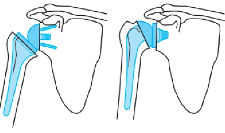 Figure 5 : Prothèse d'épaule 