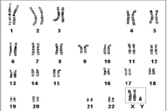 Figure 8. Caryotype d’un individu présentant un syndrome de Klinefelter, montrant un  chromosome X surnuméraire