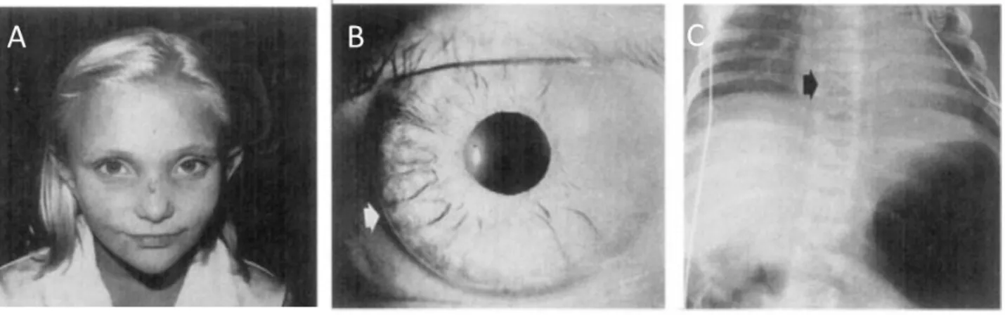 Figure 4 : Signes cliniques du syndrome d’Alagille. 