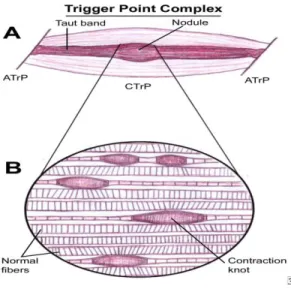 FIGURE  1 :  TRIGGER POINT  [13] 