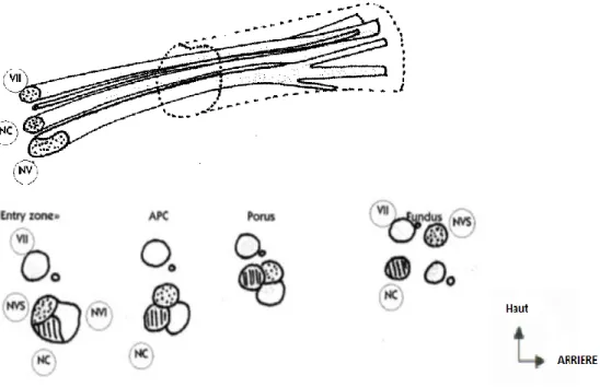 Figure  4 :  d’après  J.M  Prades  (neurinome  de  l’acoustique  SFORL  2001  O.Sterkers 11 )  trajet du pédicule acoustico-facial dans l’APC et le MAI