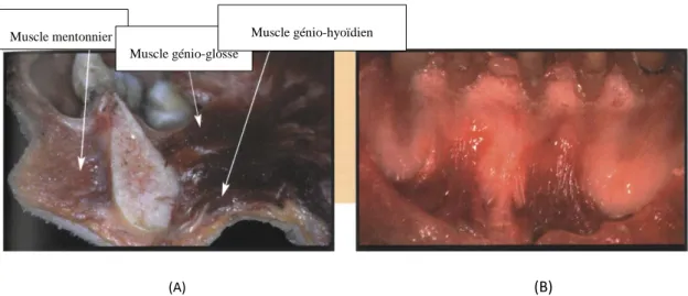 Figure 11 : La résorption dans la région incisivo-canine mandibulaire entraîne la formation d’une  crête en lame de couteau (A), et un déplacement de l’insertion du muscle mentonnier (B) 