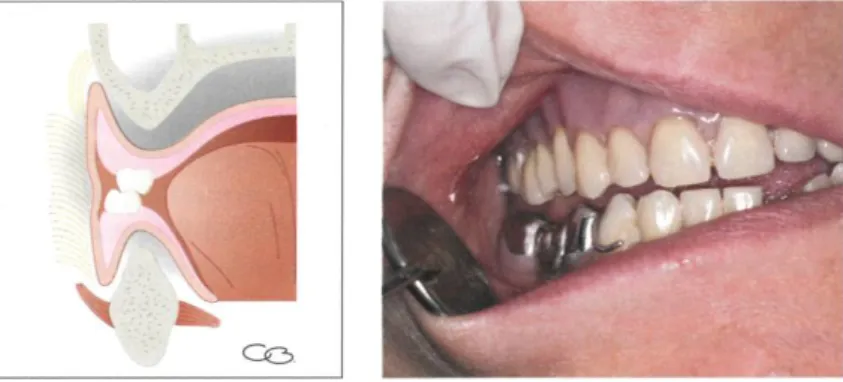 Figure 14 : Montage des molaires maxillaires en dehors de la crête pour un articulé correct 