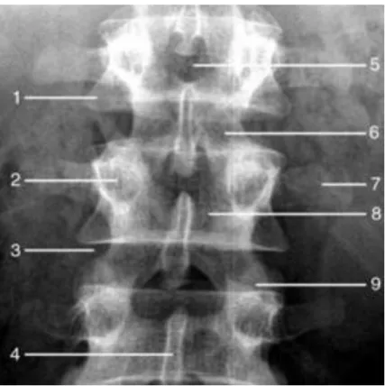 figure 10: radiographie du rachis lombaire de face (d’après EMC)