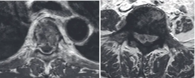Figure 5: Métastases ostéocondensantes d’un cancer de prostate avec épidurite tumorale      