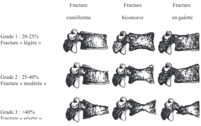 Figure 14 : Classement des fractures-tassements vertébrales                     Méthode visuelle semi quantitative de Genant 