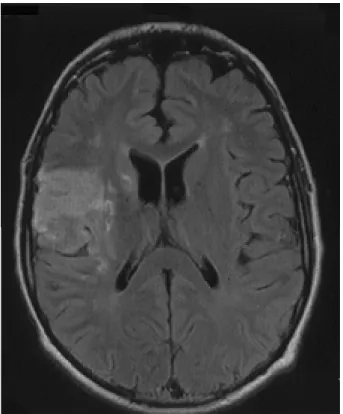 Figure 1b : Scan cérébral à 2 mois de l’AVC montrant un infarctus  cérébral dans la vallée sylvienne droit