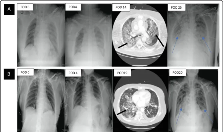 Fig. 2 Chest X-ray and CT of recipient 1 (a) and recipient 2 (b. a) Progressive occurrence of pulmonary lesions during the postoperative course.