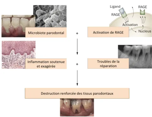 Figure 8: Le modèle « Two hit » pour la pathogenèse  de la destruction parodontale chez les  patients diabétiques 