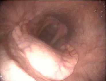 Fig 4:  Resting upper airway endoscopy of case 1 performed three  years after tie-forward surgery