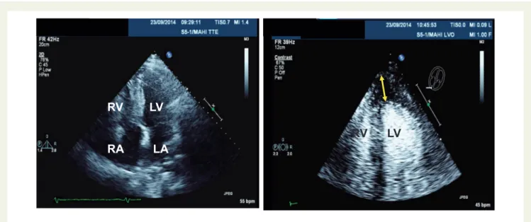 Figure 5 Four-chamber view with incidental finding of a confined echo-free area asterisk denotes adjacent to the LV apex (left).