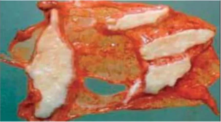 Figure 7 : Vue macroscopique de plaques pleurales.  Source : Beigelman-Aubry C et al. : Atlas iconographique  tomodensitométrique des pathologies bénignes de l’amiante