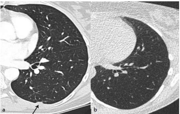 Figure 14 : Plaques pleurales diaphragmatiques en vue coronale et sagittale, chez un patient de 75 ans issus  de notre série