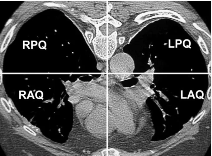 Figure  17 :  Division  du  thorax  en  4  quadrants.  R :  right,  L :  left,  A :  anterior  P :  posterior,  Q :  quadrant