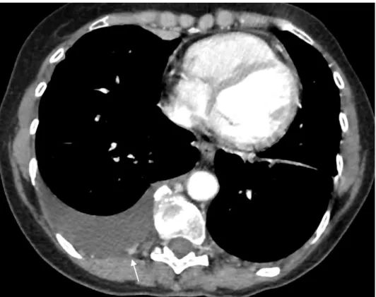 Figure 21 : Épanchement pleural droit avec nodule pleural suspect, chez un patient de 72 ans issu de la  cohorte ARDCO.