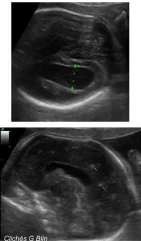 figure 28 : Toxoplasmose fœtale après séroconversion à 20 SA : présence à 28 SA  d’une dilatation ventriculaire avec des nodules intracérébraux (61) 