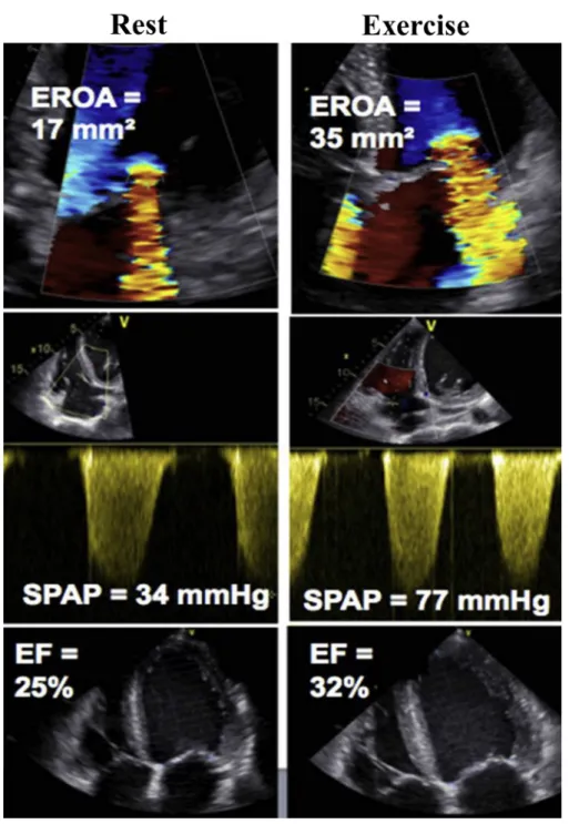 Figure 1. Exercise-induced increase in MR and in SPAP. EF ¼ ejection fraction.