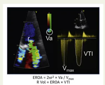 Figure 5 Evaluation of secondary mitral regurgitation with 3-dimensional transoesophageal echocardiography