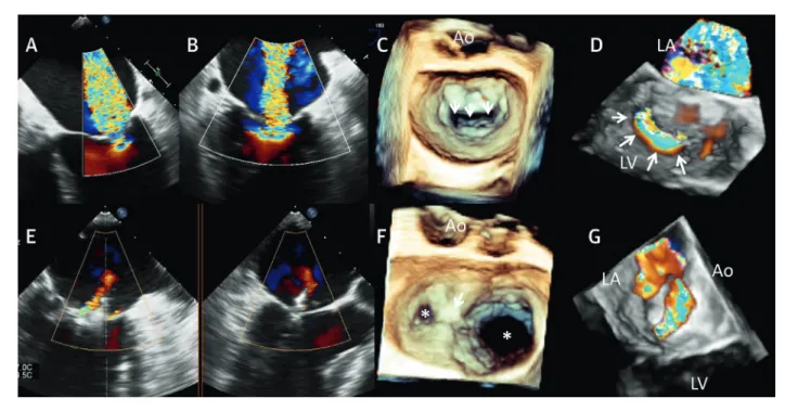 FIGURE 8 Transesophageal Echocardiogram Evaluation of MitraClip Implantation in a Patient With Severe Secondary Mitral Regurgitation