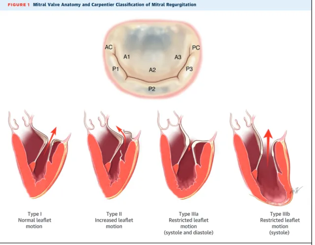 FIGURE 1 Mitral Valve Anatomy and Carpentier Classiﬁcation of Mitral Regurgitation