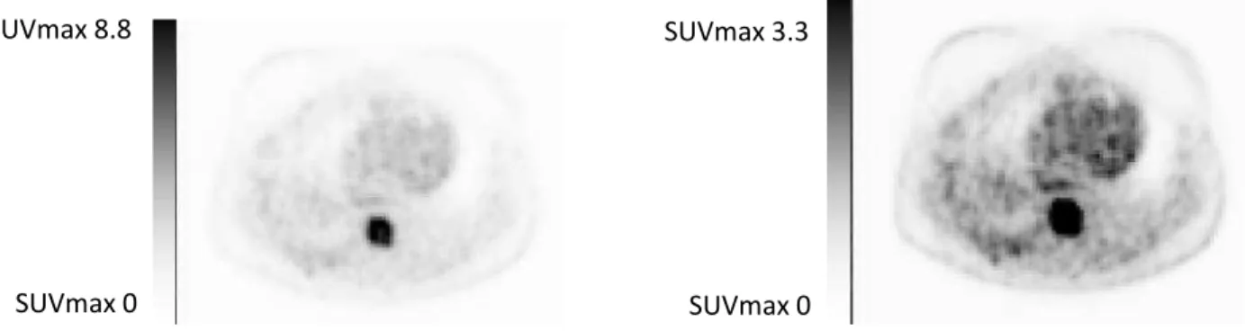 Figure 5 : Coupe axiale d’image TEP,  avec 2 seuillages d’échelle de SUV différents. 