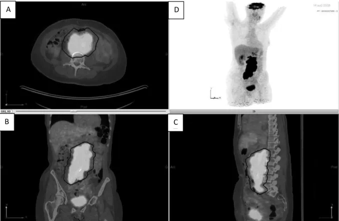 Figure 6 : Images de fusion TEP/TDM en coupes axiale (A), coronale (B) et sagittale (D) et  en Maximal intensity projection  (D)