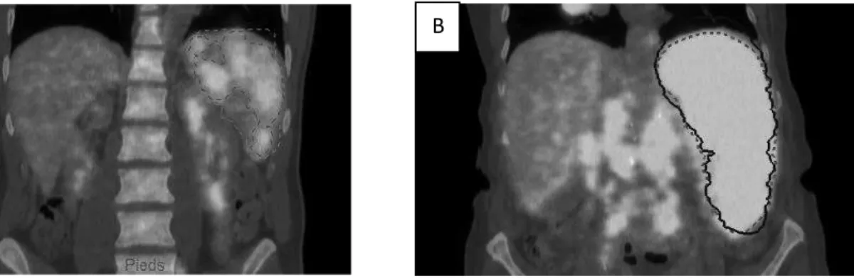 Figure 8 : Images de fusion TEP/TDM, en coupe coronale. Atteinte splénique focale (A) ou  diffuse (B)