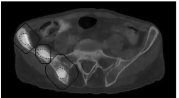 Figure 9 : Image de fusion TEP/TDM, en coupe axiale, trois lésions osseuses focales de l’aile  iliaque droite