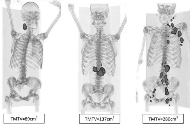 Figure 12 : Exemples de fortes masses tumorales (TMTV&gt;300cm 3 ) 