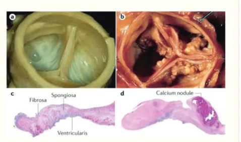 Figure 1: A: Valve aortique saine B: Valve aortique sévèrement sténosée  et calcifiée 