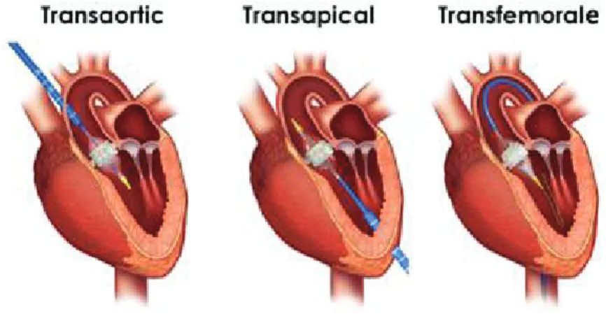 Figure 3: Voies d'abord développées pour l'implantation du TAVI  Remplacement valvulaire aortique par voie transcathéter Martinez C et Coll 
